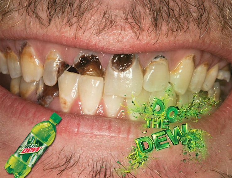 Mountain Dew Mouth' Is Destroying Appalachia's Teeth, Critics Say